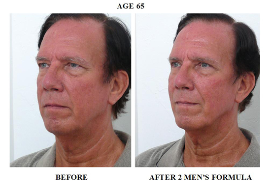 Men's-Face-Formula-after-2-months