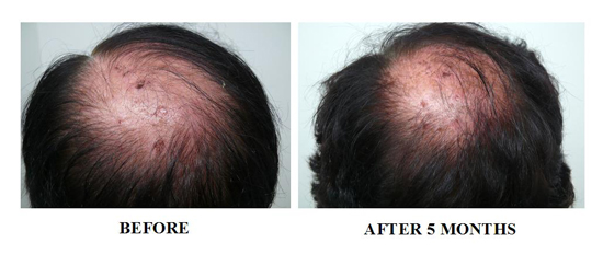 Men's-Hair-Formula-after-5-months